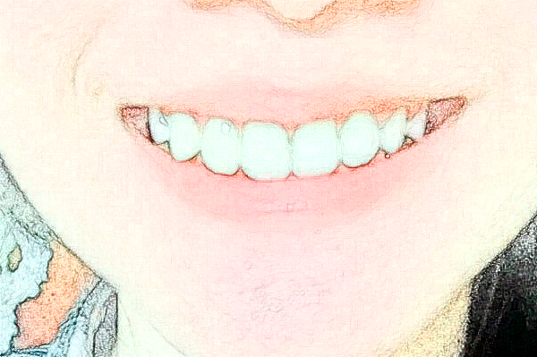 武漢德韓口腔醫(yī)院種植牙怎么樣?種植牙能維持幾年