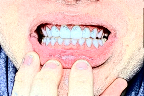 鄭州唯美口腔醫(yī)院種植牙價(jià)格多少?整形日記全過(guò)程分享