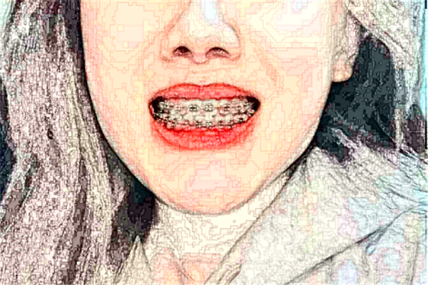 2024福州美橙口腔牙列擁擠矯正哪個(gè)醫(yī)生好?專家名單+案例反饋