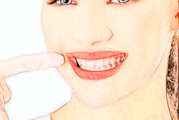 2024河南美奧口腔醫(yī)院瓷貼面價(jià)格?瓷貼面有哪幾種