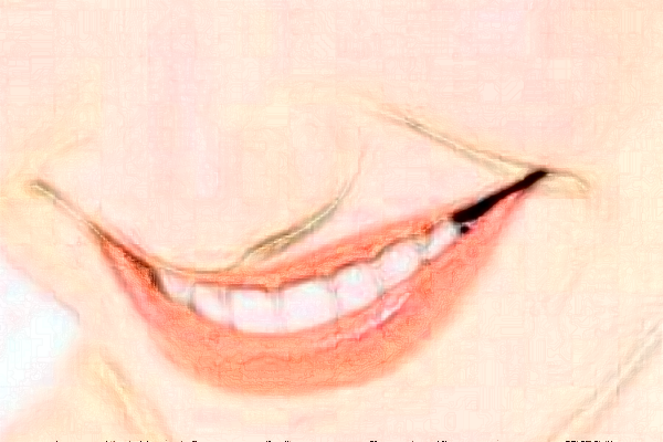 2024深圳樂莎莎口腔醫(yī)院拔牙費(fèi)用?拔牙后注意事項(xiàng)