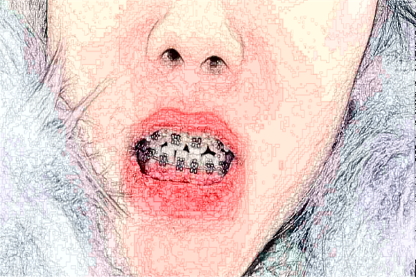 2024貴陽柏德口腔醫(yī)院瓷貼面怎么樣_專家信息_案例大全欣賞