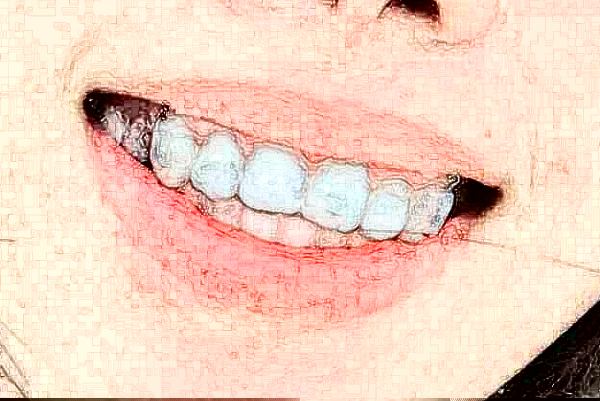 深圳樂莎莎口腔醫(yī)院超聲波洗牙原理?超聲波洗牙疼不疼