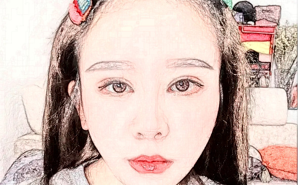 烏魯木齊子桐整形醫(yī)院玻尿酸去川字紋技術怎么樣?報價多少?案例曝光