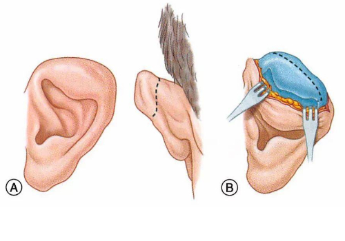 寧波整形外科醫(yī)院杯狀耳整形怎么樣?價格?術后120天案例&技術級別