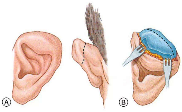 西安碑林眾心醫(yī)院杯狀耳矯正技術(shù)怎么樣?費(fèi)用標(biāo)準(zhǔn)?術(shù)后半年案例