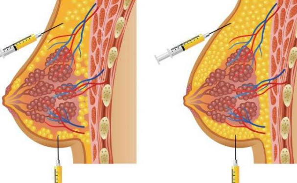 焦作市第二人民醫(yī)院燒傷整形美容科自體脂肪隆胸費用多少?技術(shù)等級怎么樣?
