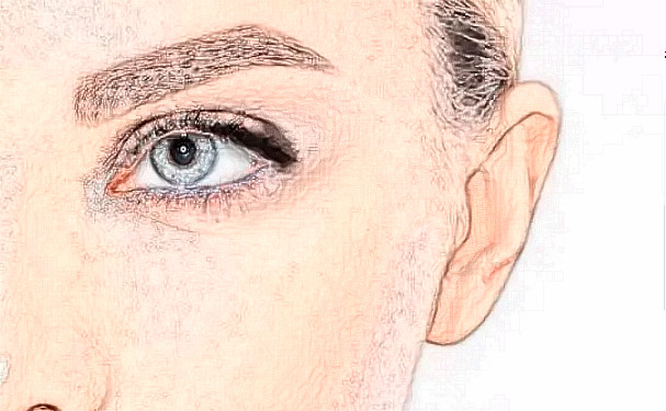 檸悅美容整形做腫泡眼雙眼皮技術(shù)怎么樣?費用查詢?術(shù)后半年案例點評