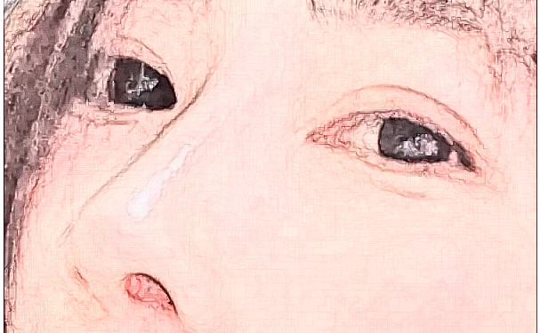 成都美容整形醫(yī)院定點雙眼皮術(shù)后三個月求美案例|技術(shù)水平怎么樣?費用查詢