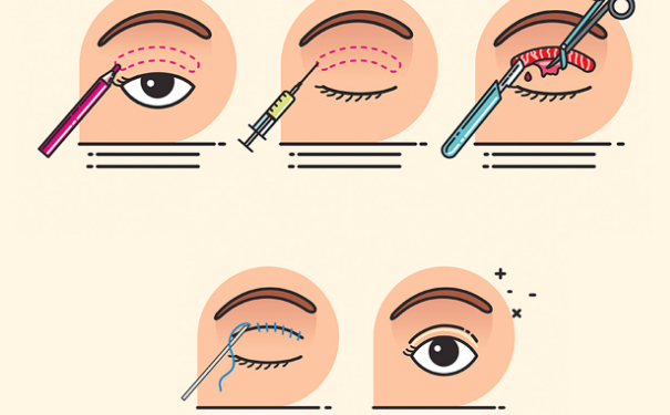 大連市星妍醫(yī)療美容診所新月雙眼皮技術(shù)評(píng)測(cè)怎么樣?術(shù)后半年案例揭秘