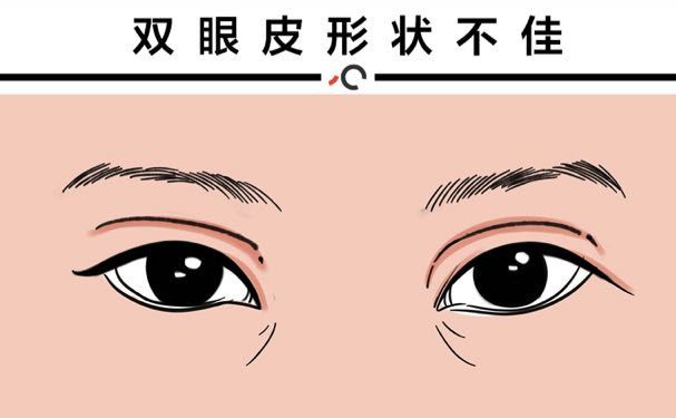 杭州蕭山詮昕醫(yī)療美容門(mén)診部扇形雙眼皮費(fèi)用查詢(xún)?技術(shù)評(píng)測(cè)&術(shù)后三個(gè)月案例曝光