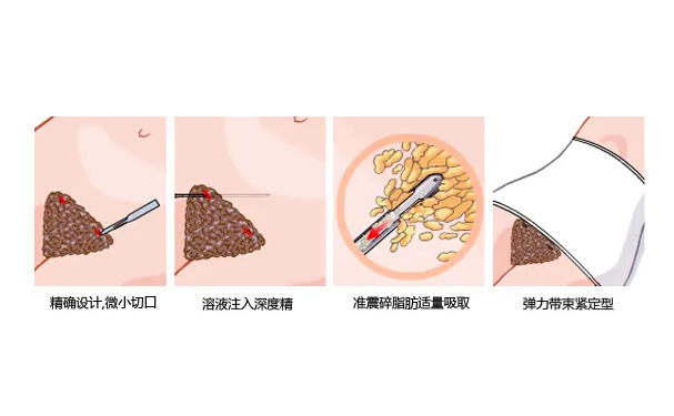 佛山順德壹加壹美容醫(yī)院共振吸脂技術(shù)級別怎么樣?案例點評&費用明細