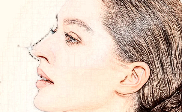 湖南禾信植發(fā)頭發(fā)種植一年案例反饋(效果怎么樣?技術(shù)亮點)