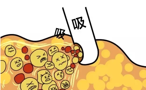 北京貴美匯醫(yī)院脂肪填充報(bào)價(jià)多少?技術(shù)優(yōu)點(diǎn)怎么樣?