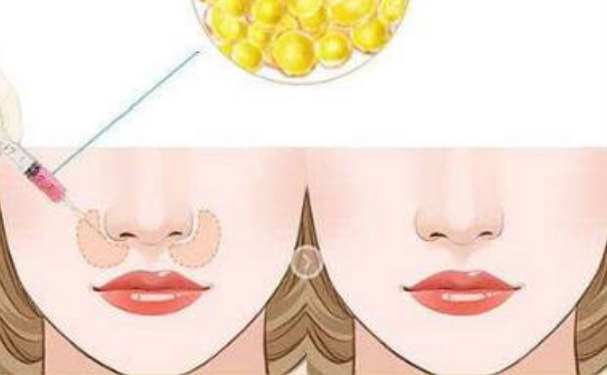 宜昌市中心人民醫(yī)院膠原蛋白填充鼻唇溝醫(yī)生排名,費用明細?心動案例