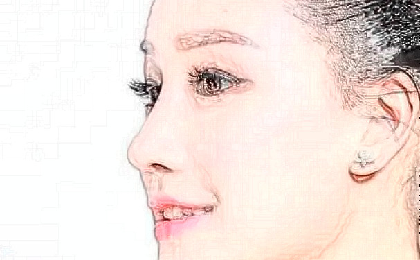 成都藝星謝雯面部提升求美案例&技術點評