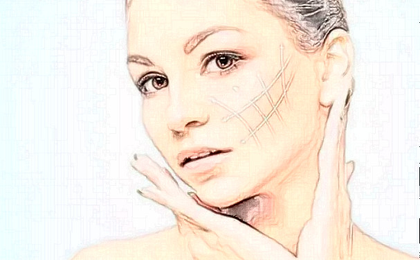 成都藝星謝雯面部提升求美案例&技術點評