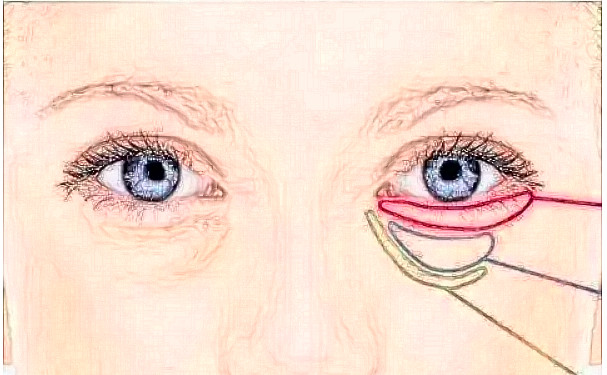 上海中山醫(yī)院做眼袋恢復(fù)案例&技術(shù)怎么樣?